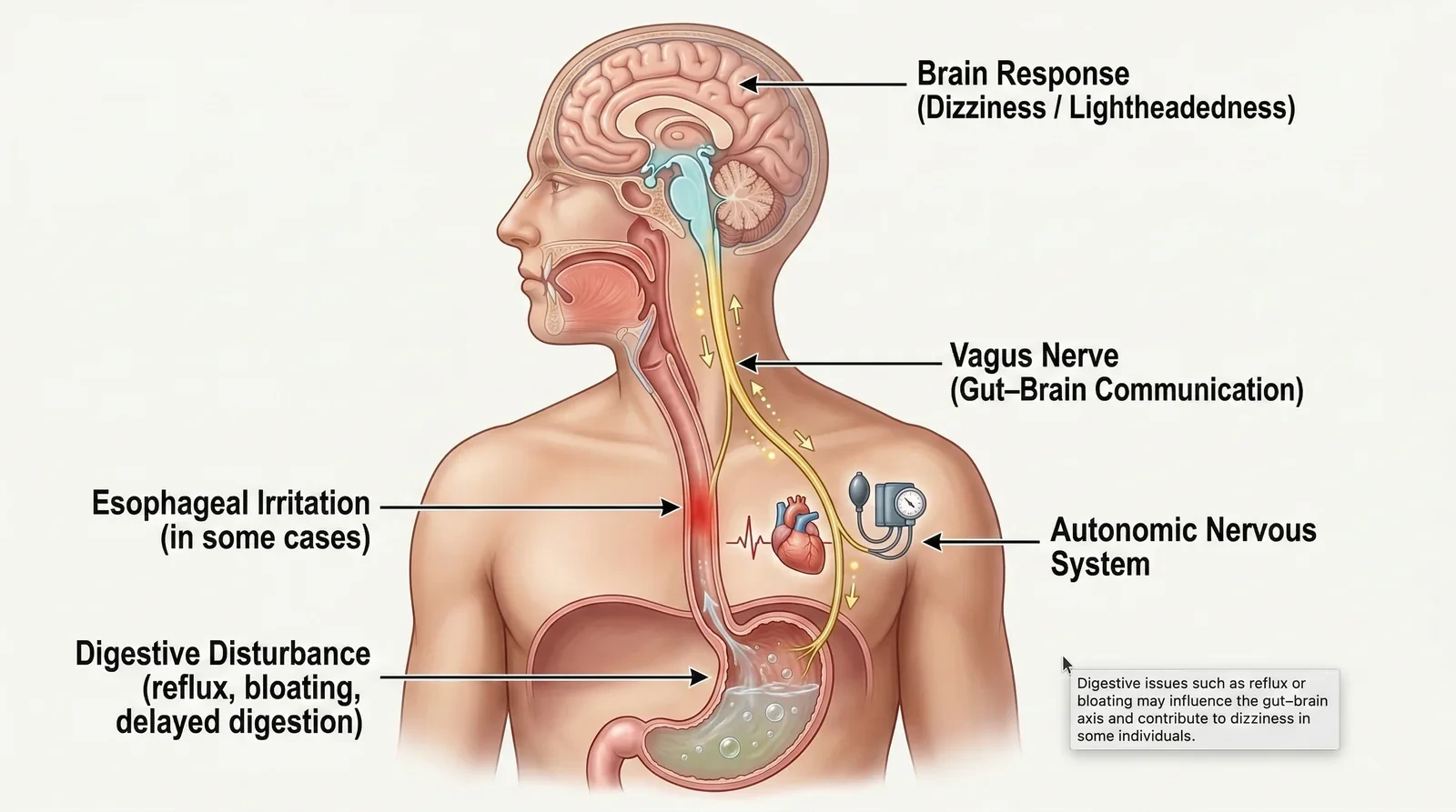 Illustration of how reflux may contribute to dizziness through gut-brain signaling