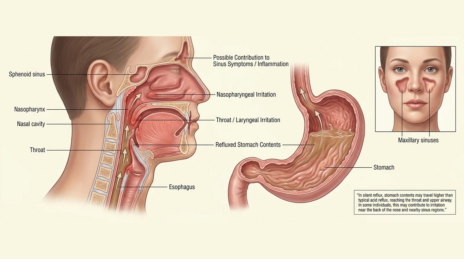 Illustration of reflux reaching the throat and back of the nose, with a possible connection to sinus irritation